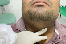 FMS alerta para sinais de câncer bucal e prioriza atendimento para casos suspeitos