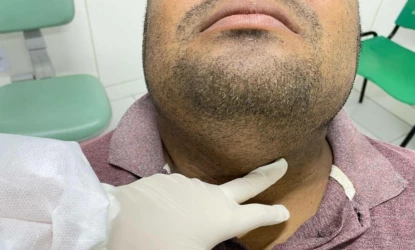 FMS alerta para sinais de câncer bucal e prioriza atendimento para casos suspeitos