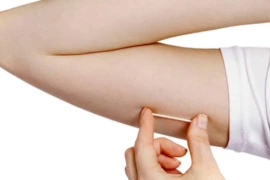 Timon recebe 600 unidades do Implanon e deve iniciar oferta do contraceptivo na rede pública em julho